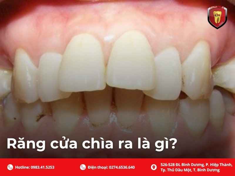 Răng cửa chìa ra là gì ?