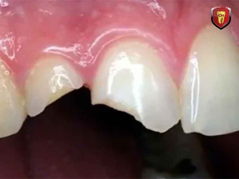 Tăng nguy cơ chấn thương răng cửa