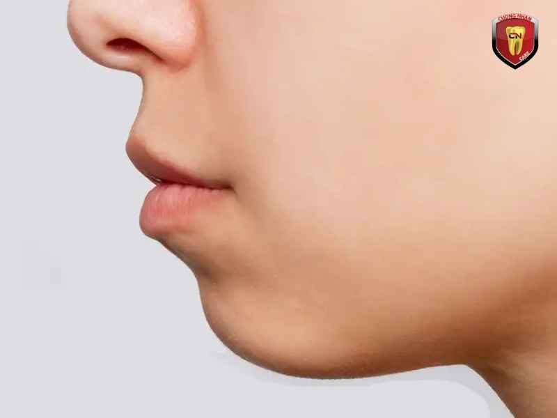Có thể ảnh hưởng phát âm