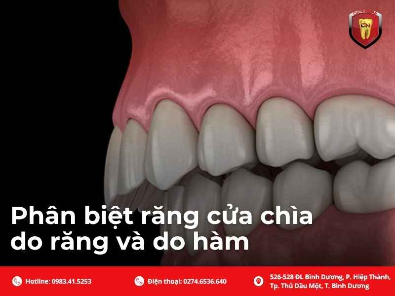 Phân biệt răng cửa chìa do răng và do hàm