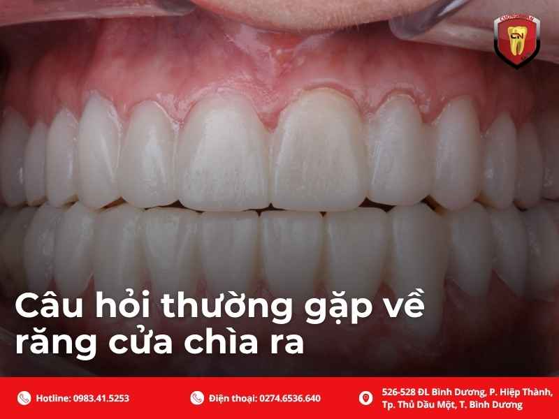 Câu hỏi thường gặp về răng cửa chìa ra