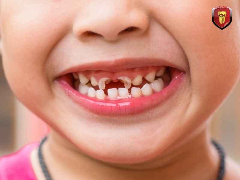 Răng sữa mất sớm hoặc thay răng không thuận lợi