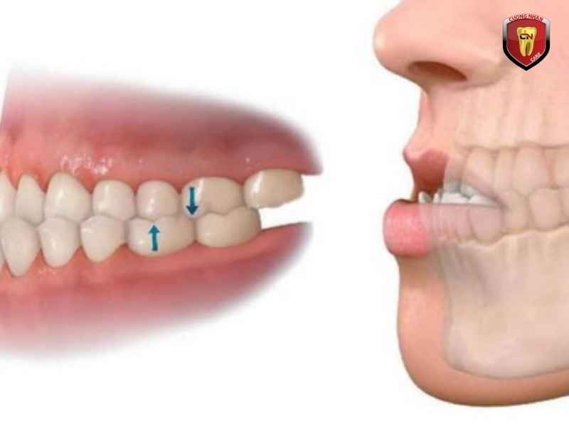 Sự phát triển không cân đối của xương hàm