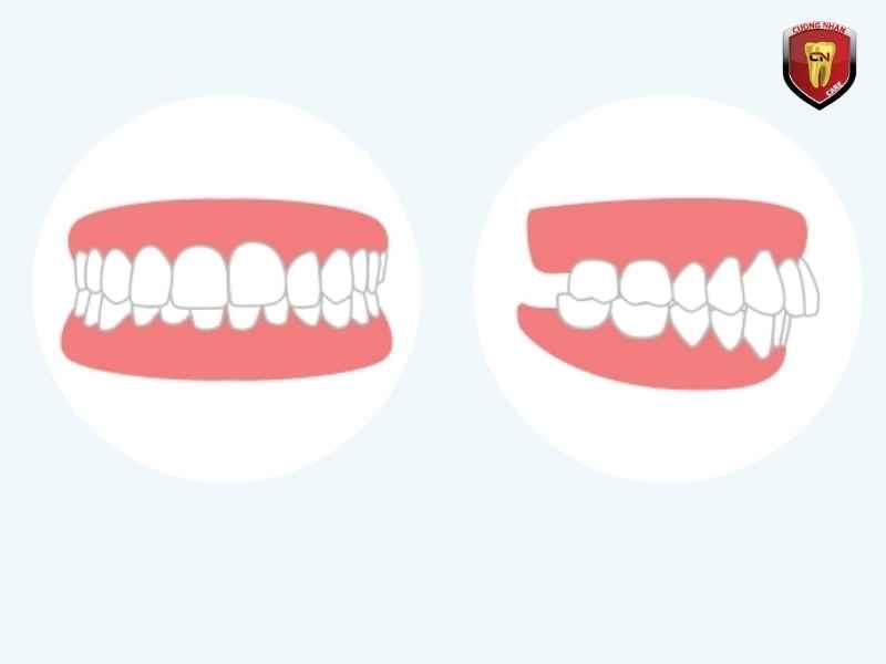Ảnh hưởng của khoảng trống và khớp cắn