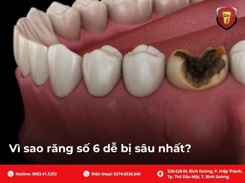Sâu răng số 6