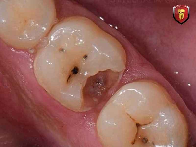 Viêm tủy răng số 6