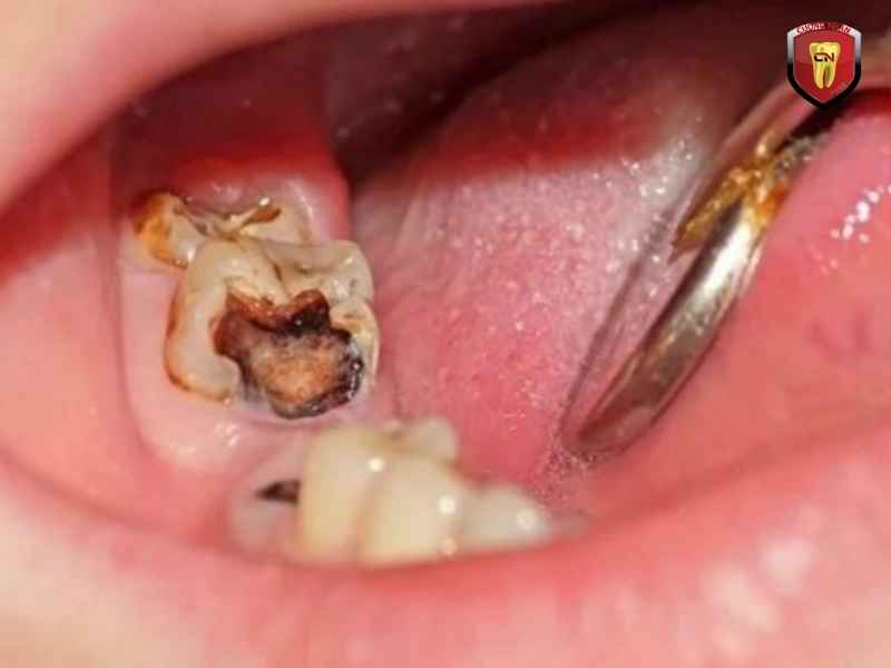 Gãy, mẻ hoặc nứt răng