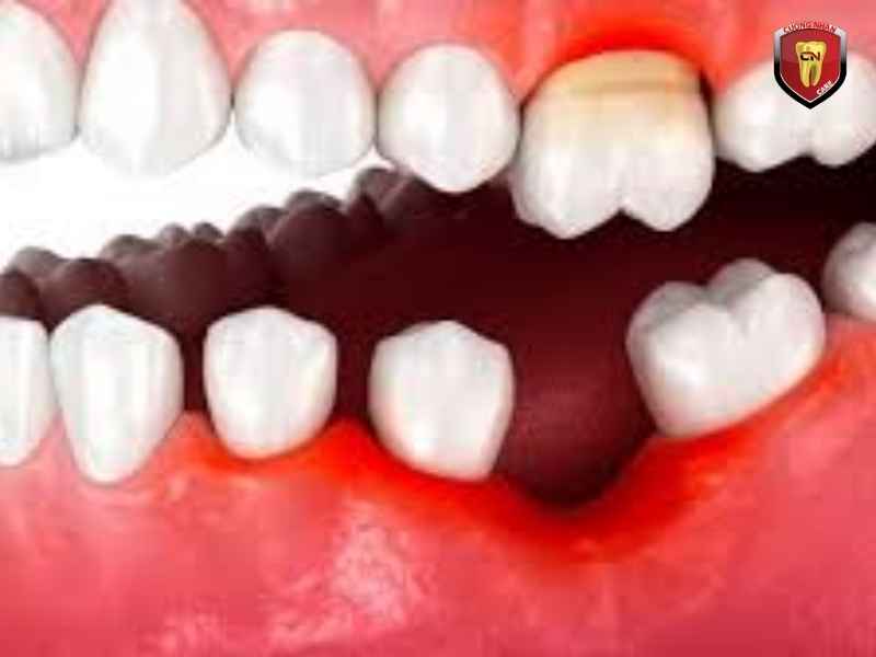 Răng số 6 bị sâu có nên nhổ không?