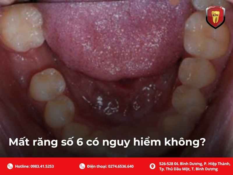 Mất răng số 6 có nguy hiểm không?