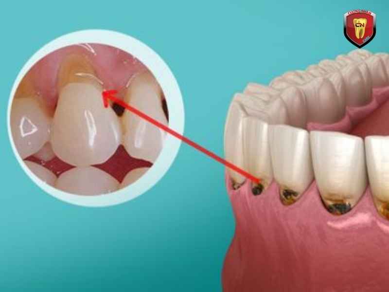 Men răng là lớp bảo vệ ngoài cùng