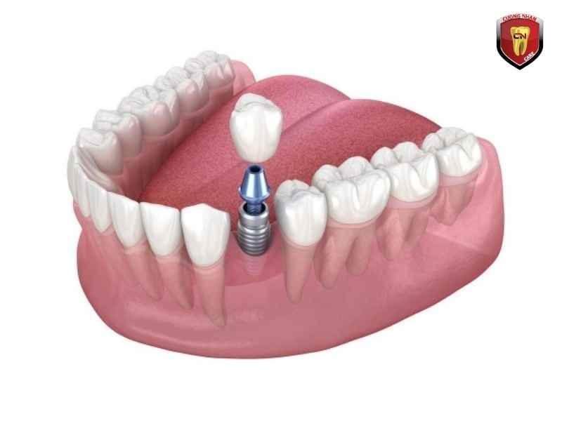 Trồng răng Implant