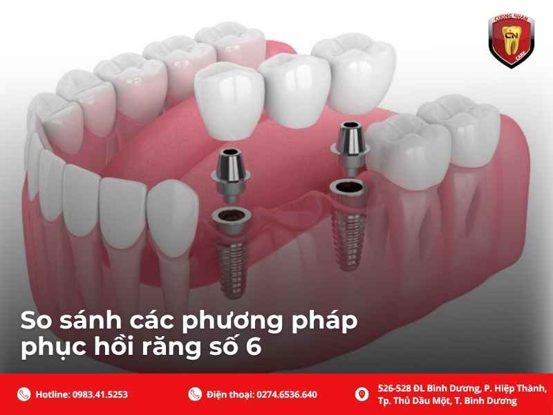 So sánh các phương pháp phục hồi răng số 6