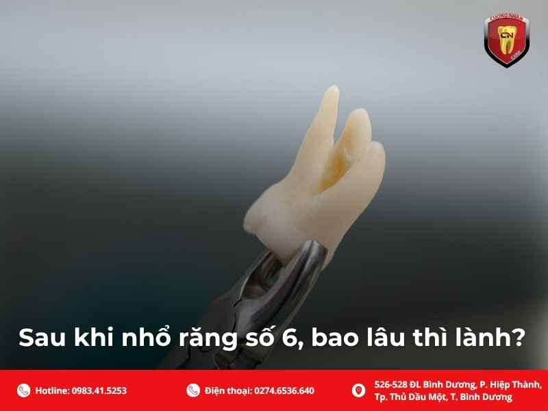 Sau khi nhổ răng số 6, bao lâu thì lành?