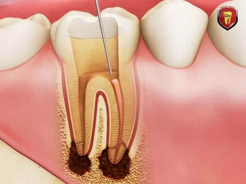 Răng số 6 có mấy chân - mấy ống tủy?