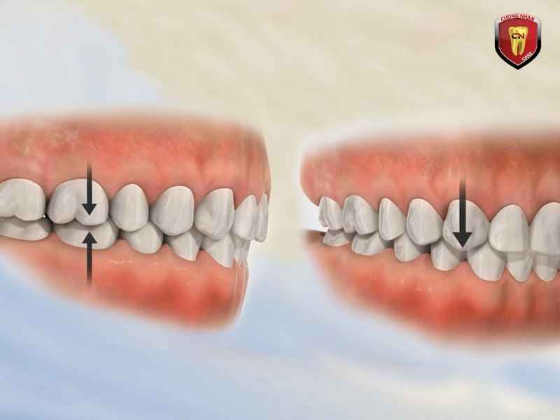 Nâng đỡ cấu trúc khuôn mặt