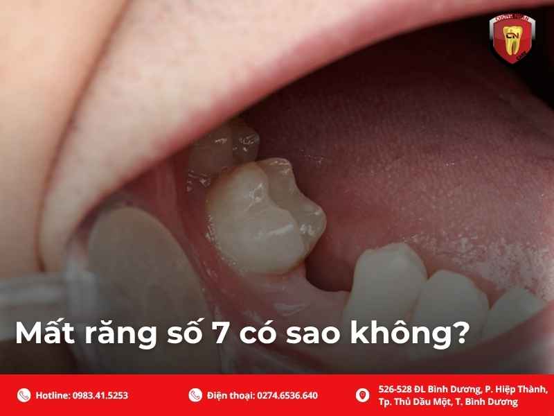 Mất răng số 7 có sao không?