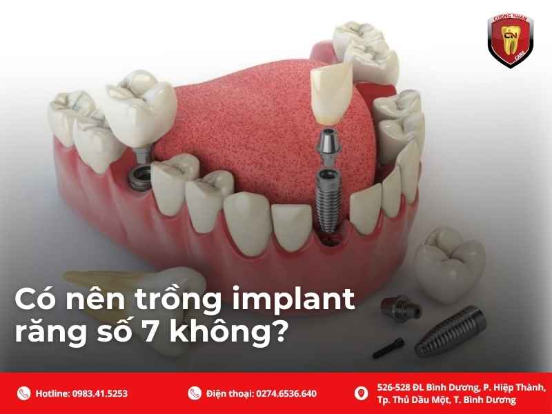 Có nên trồng implant răng số 7 không?