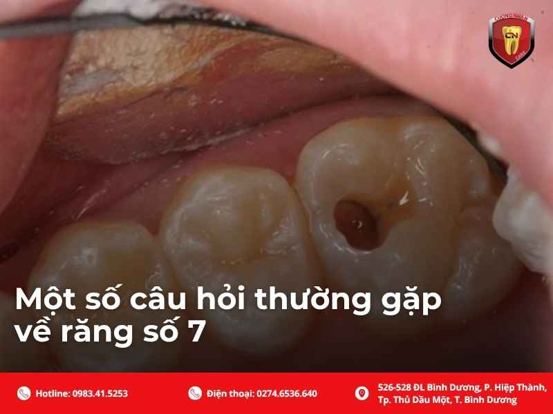 Một số câu hỏi thường gặp về răng số 7