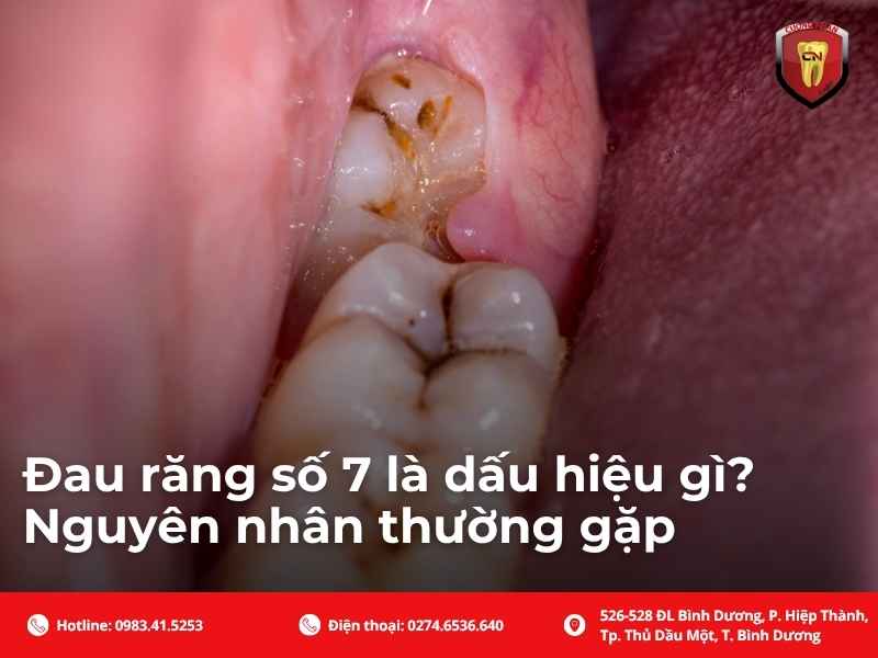 Đau răng số 7 là dấu hiệu gì? Nguyên nhân thường gặp