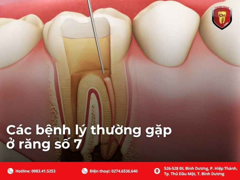 Các bệnh lý thường gặp ở răng số 7