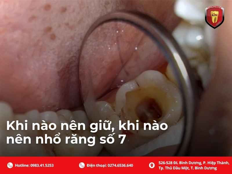Khi nào nên giữ, khi nào nên nhổ răng số 7