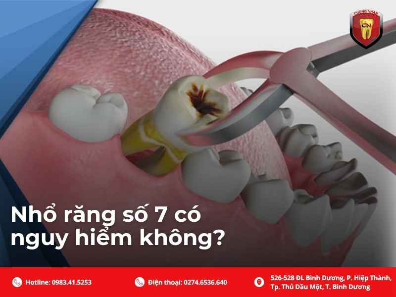 Nhổ răng số 7 có nguy hiểm không?