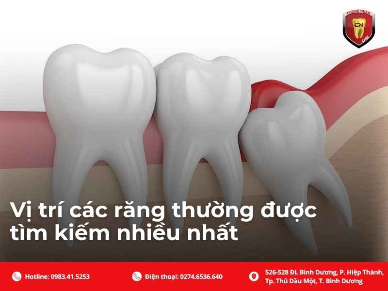 Vị trí các răng thường được tìm kiếm nhiều nhất