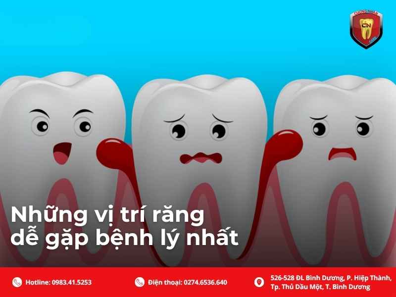 Những vị trí răng dễ gặp bệnh lý nhất