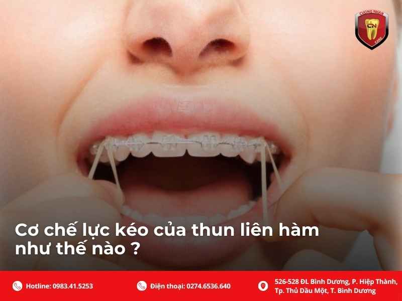 Hướng dẫn đeo thun tại nhà, làm đúng ngay từ lần đầu