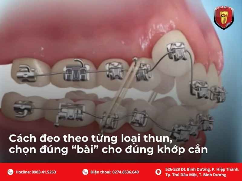 Cách đeo theo từng loại thun, chọn đúng “bài” cho đúng khớp cắn