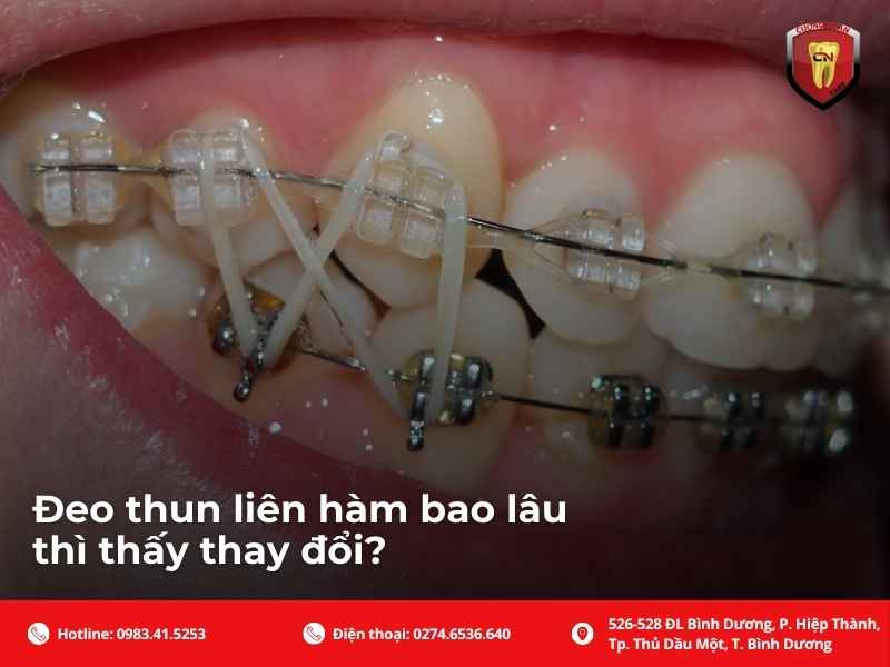 Đeo thun liên hàm bao lâu thì thấy thay đổi?