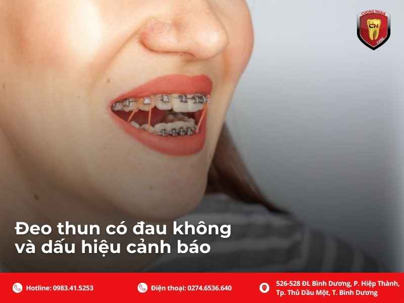Đeo thun có đau không và dấu hiệu cảnh báo