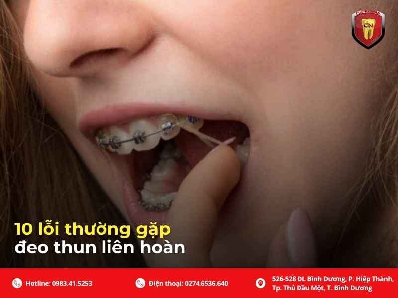 10 lỗi thường gặp khi đeo thun liên hoàn