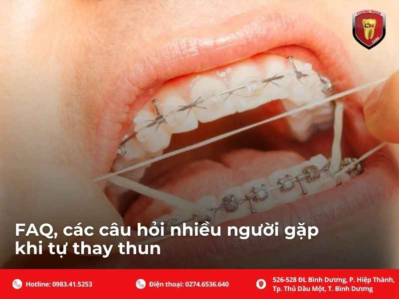 FAQ, các câu hỏi nhiều người gặp khi tự thay thun