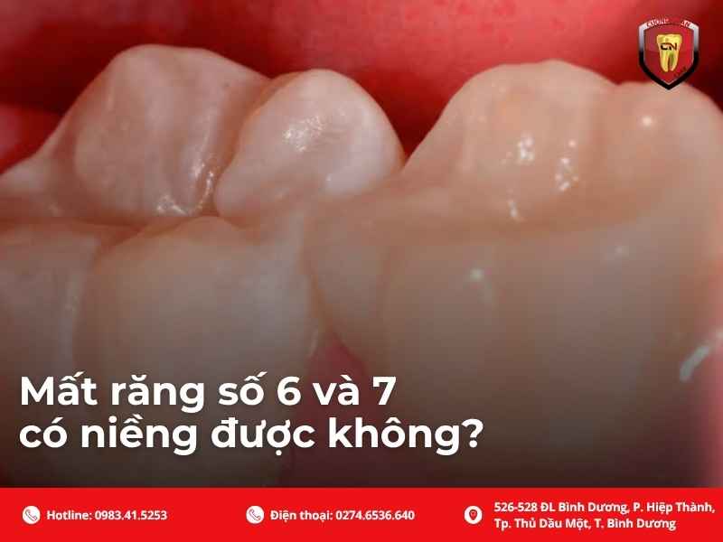 Mất răng số 6 và 7 có niềng được không?