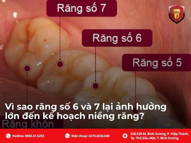 Vì sao răng số 6 và 7 lại ảnh hưởng lớn đến kế hoạch niềng răng?
