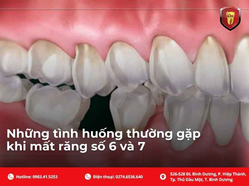Những tình huống thường gặp khi mất răng số 6 và 7