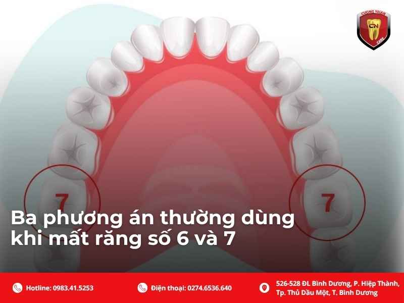 Ba phương án thường dùng khi mất răng số 6 và 7