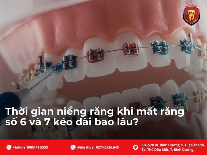 Thời gian niềng răng khi mất răng số 6 và 7 kéo dài bao lâu?
