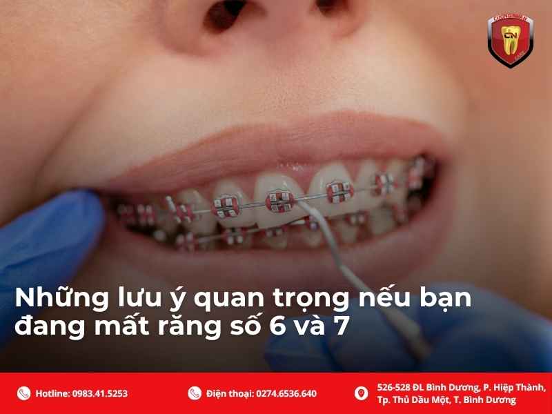 Những lưu ý quan trọng nếu bạn đang mất răng số 6 và 7