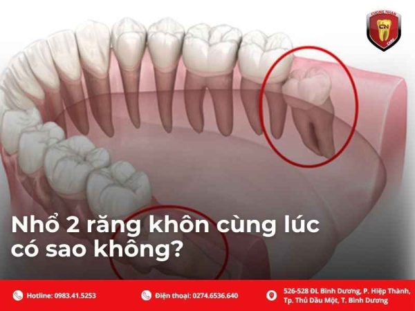 Nhổ 2 răng khôn cùng lúc có sao không?
