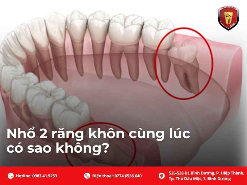Nhổ 2 răng khôn cùng lúc có sao không?
