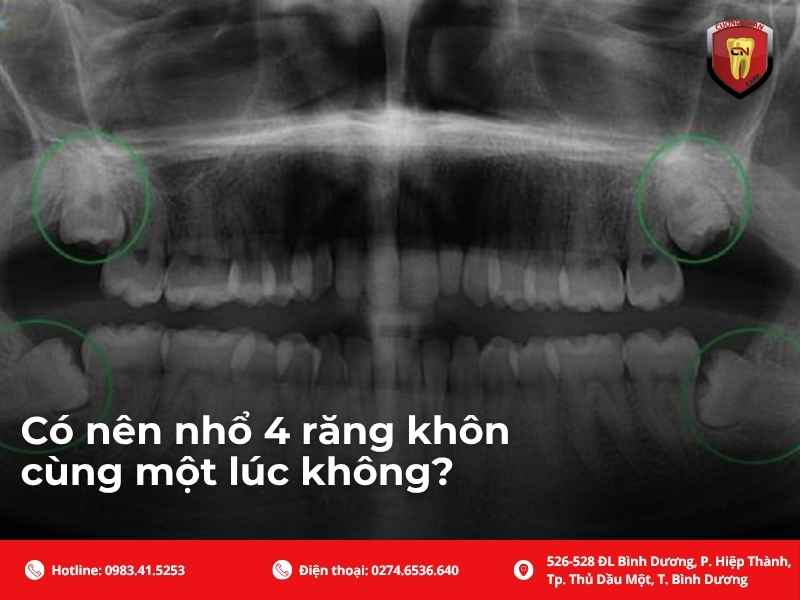 Có nên nhổ 4 răng khôn cùng một lúc không?