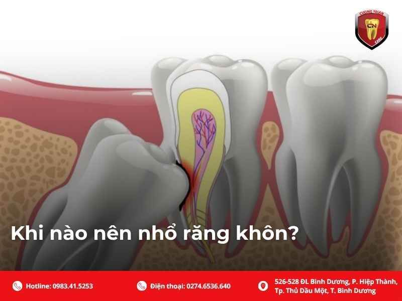 Khi nào nên nhổ răng khôn?