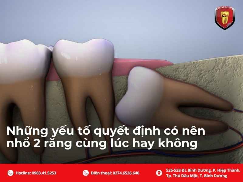 Những yếu tố quyết định có nên nhổ 2 răng cùng lúc hay không