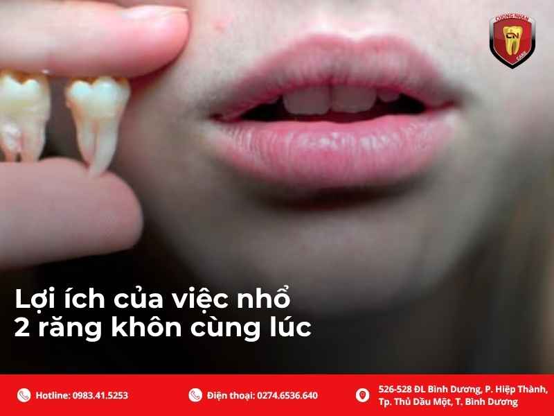 Lợi ích của việc nhổ 2 răng khôn cùng lúc