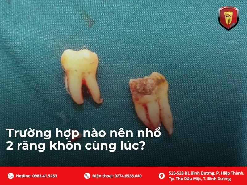Trường hợp nào nên nhổ 2 răng khôn cùng lúc?