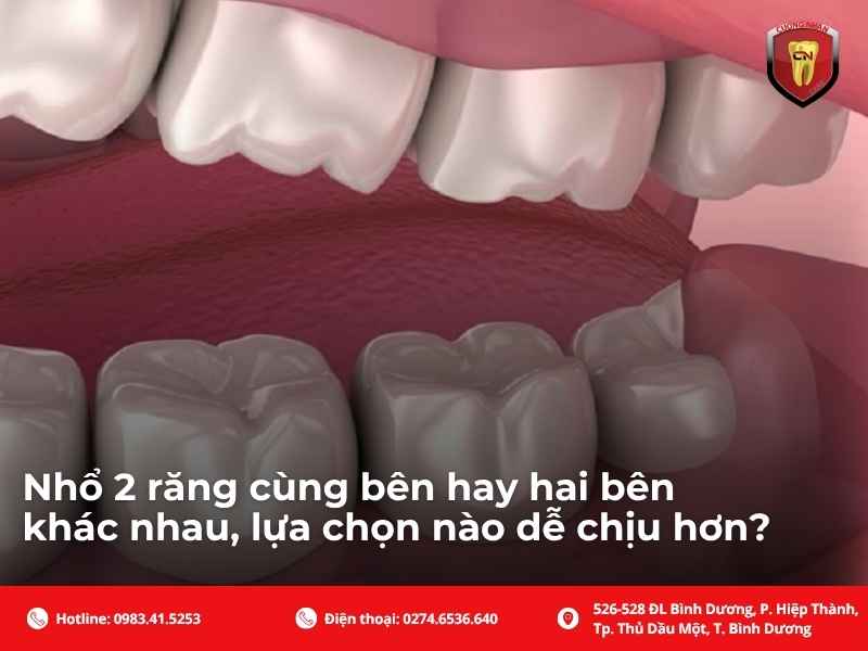 Nhổ 2 răng cùng bên hay hai bên khác nhau, lựa chọn nào dễ chịu hơn?