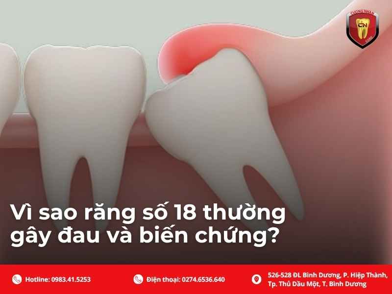 Vì sao răng số 18 thường gây đau và biến chứng?