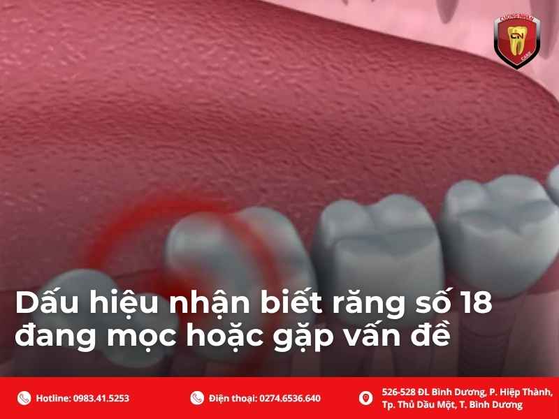 Dấu hiệu nhận biết răng số 18 đang mọc hoặc gặp vấn đề